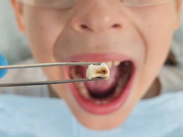 Best Emergency Dentist for Knocked-Out Tooth in USA